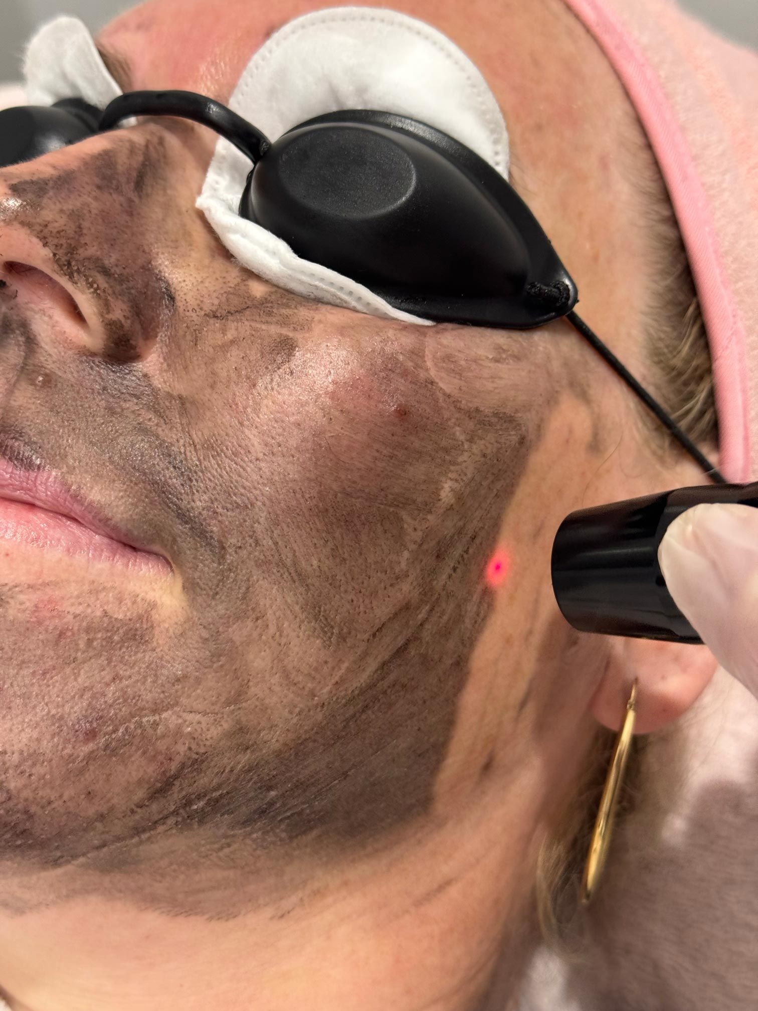 Carbon Laser Facial