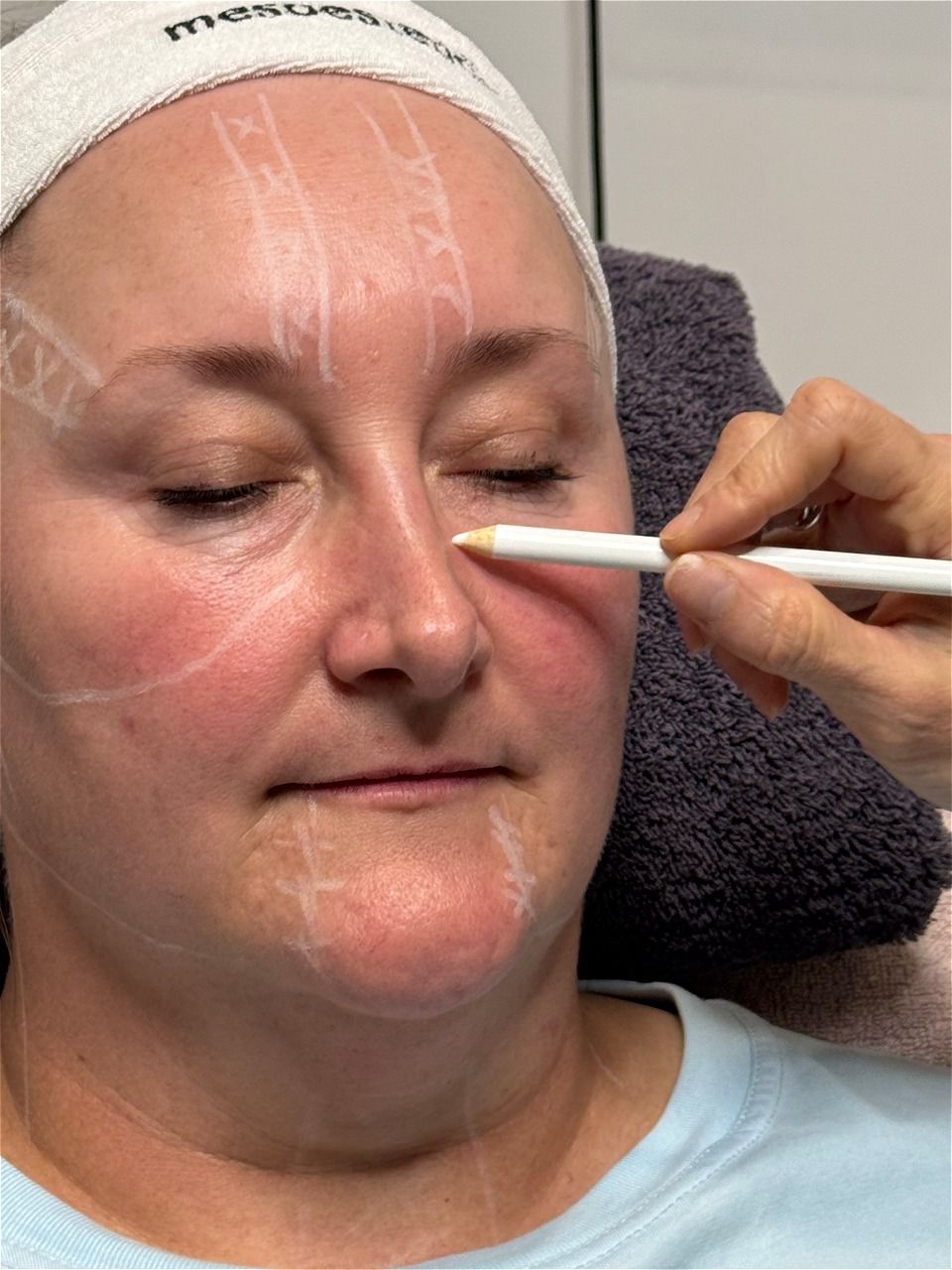 HIFU Skin Tightening