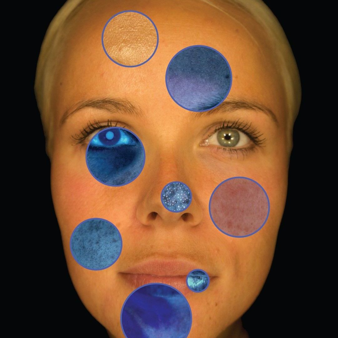 Observ 520 Skin Analysis